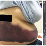 Американка кашлянув, сломала себе два ребра (фото)